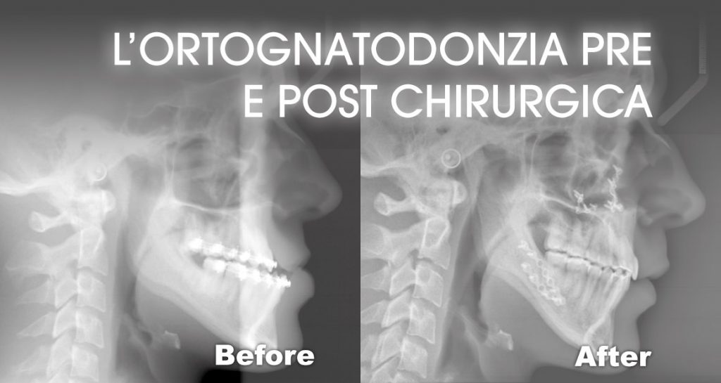 Ortognatodonzia pre e post chirurgica in Studio Cagnin