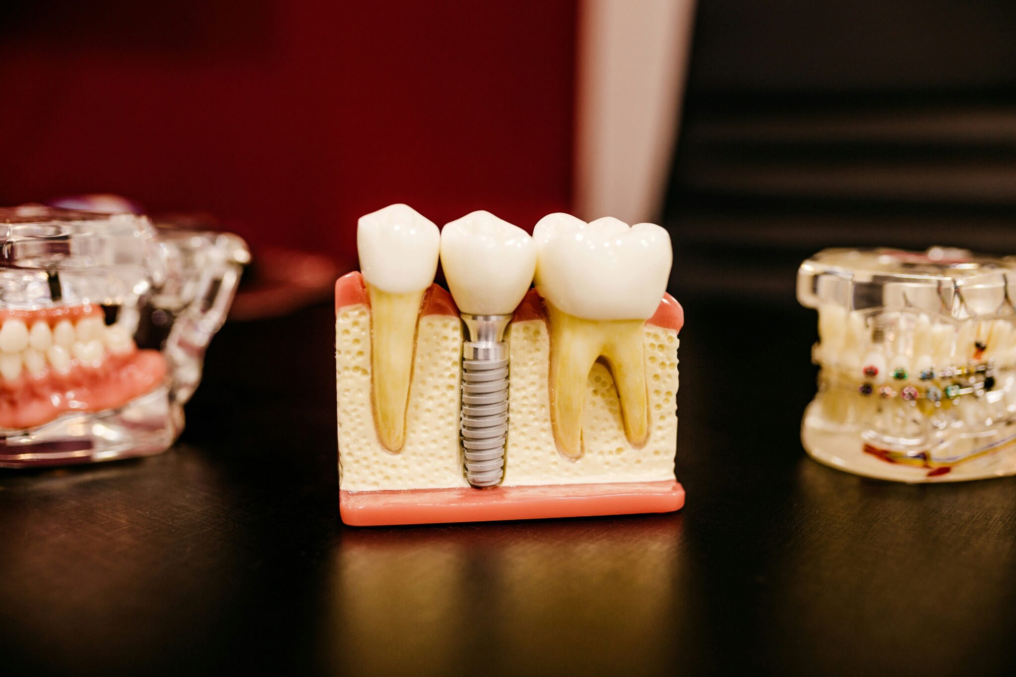 specifiche sui costi impianti dentali